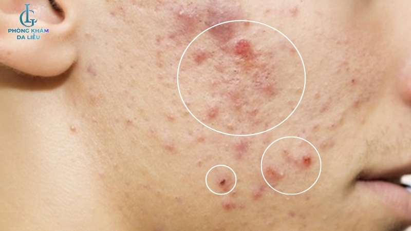 điều trị sẹo rỗ bằng vitamin e