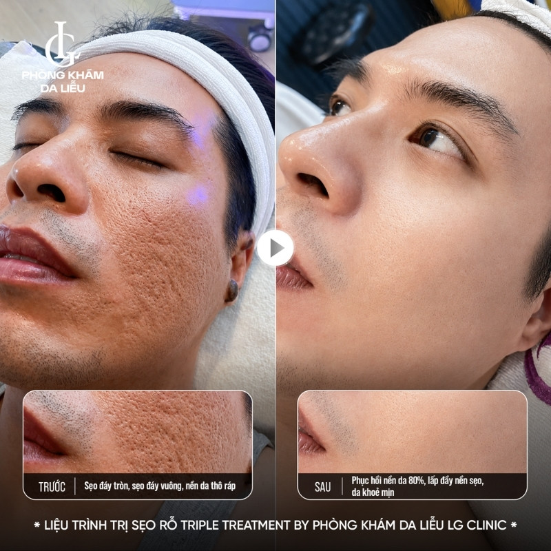điều trị sẹo rỗ lâu năm