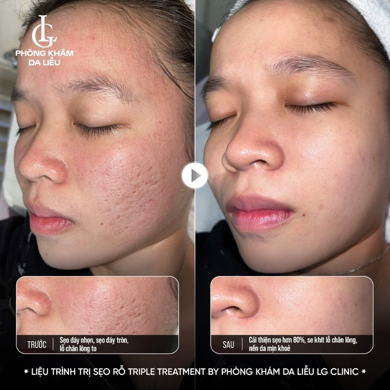 hiệu quả trị sẹo rỗ lâu năm