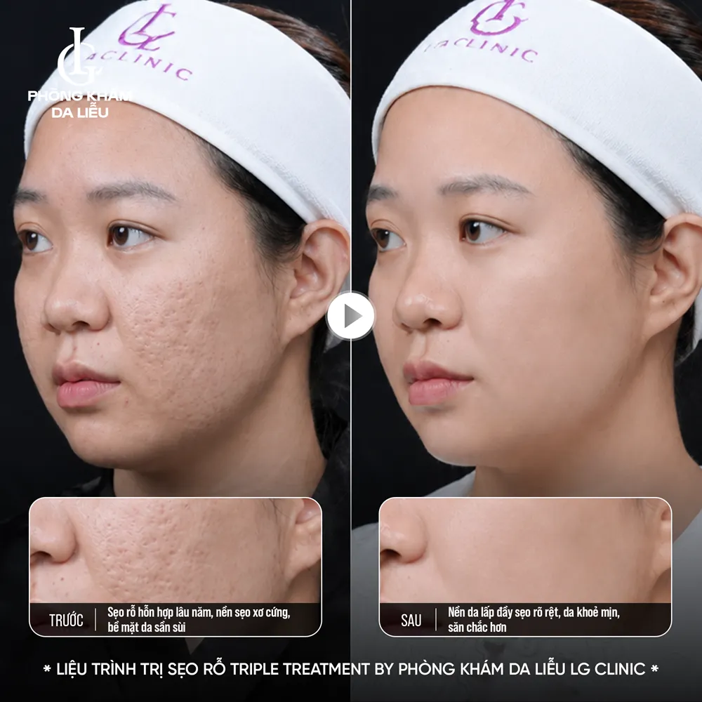 hình ảnh ba triple treatment