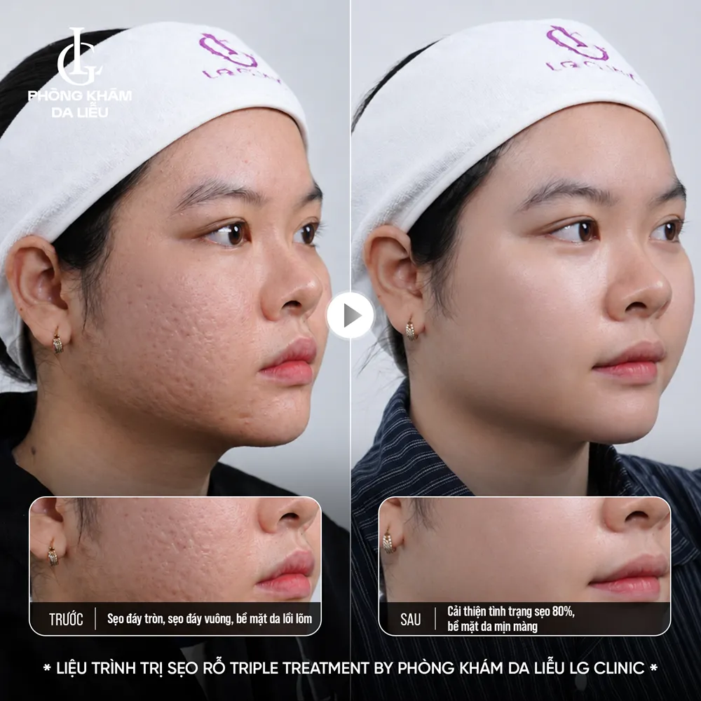 hình ảnh ba triple treatment