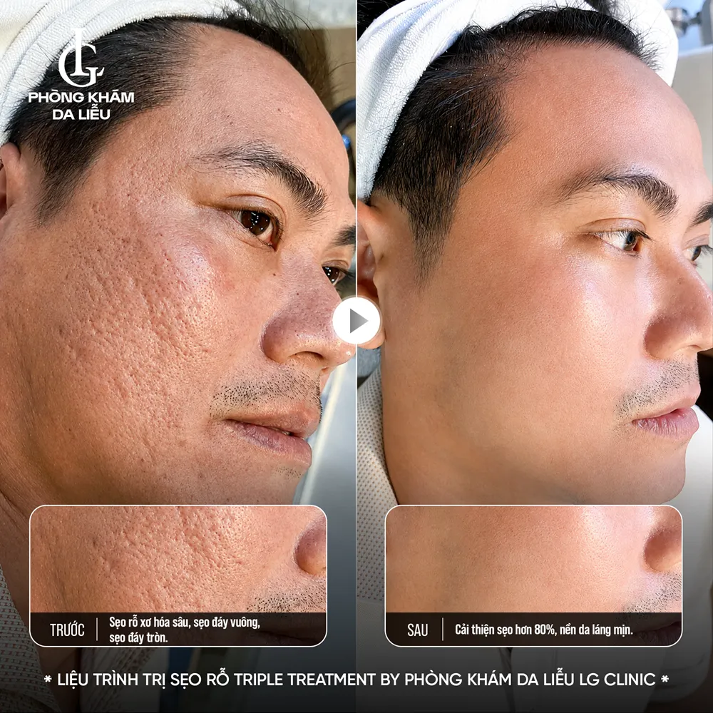 hình ảnh ba triple treatment