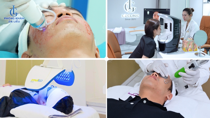 kinh nghiệm trị sẹo rỗ lâu năm