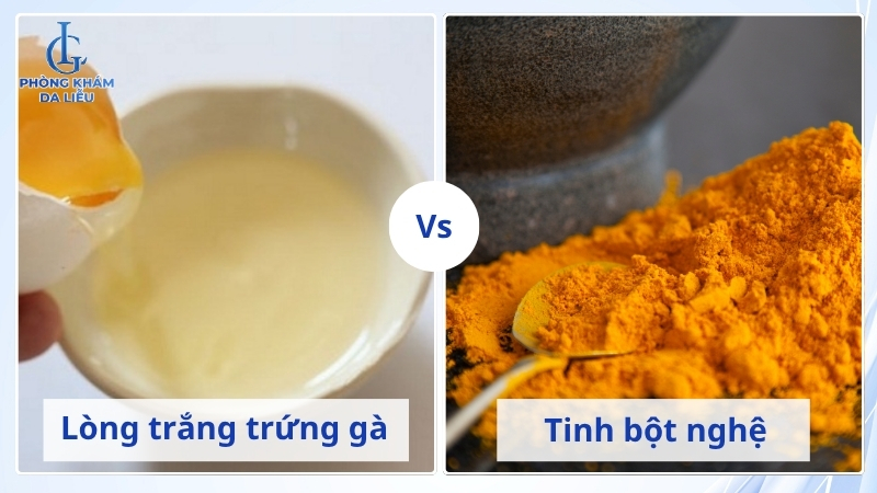 công thức làm mặt nạ trứng gà trị sẹo rỗ