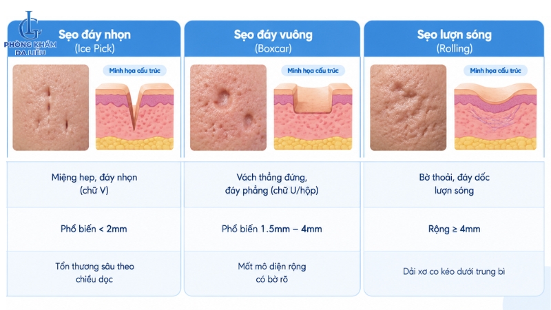 phân loại các loại sẽo rỗ