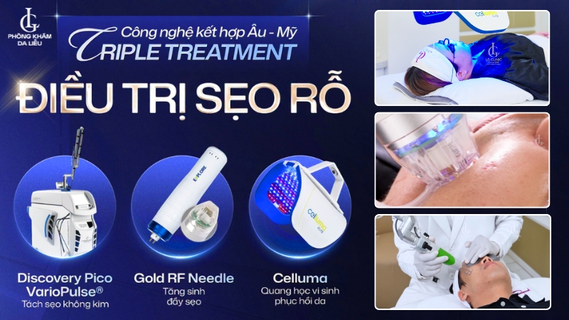 Triple Treatment - phương pháp trị các loại sẹo rỗ