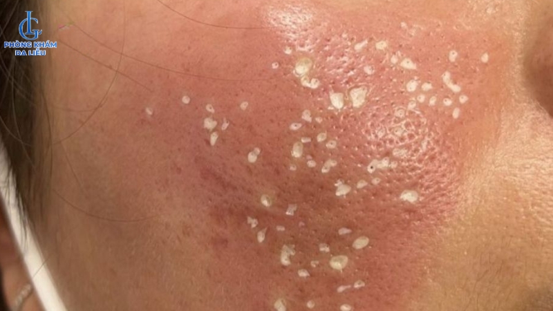 phương pháp trị sẹo rỗ đáy nhọn