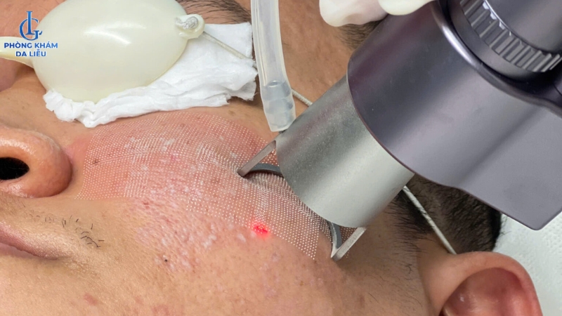 phương pháp trị sẹo rỗ đáy vuông