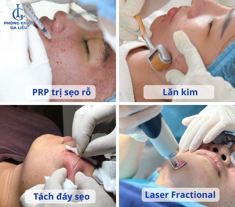 prp điều trị sẹo rỗ