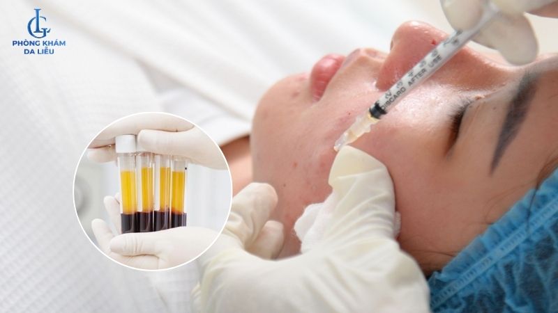 prp trị sẹo rỗ