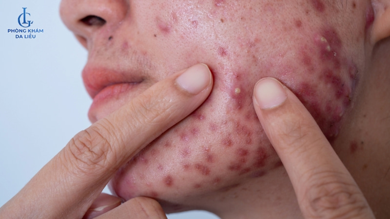 rủi ro dùng mỡ trăn trị sẹo lõm