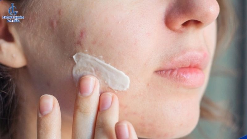 Duy trì sử dụng kem trị sẹo rỗ đều đặn để thấy được hiệu quả