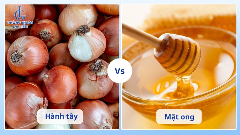 điều trị sẹo lõm bằng hành tây và mật ong