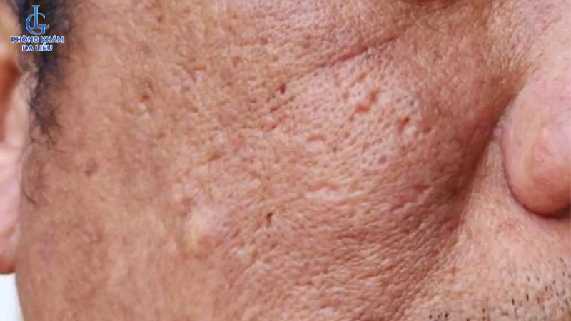 trị sẹo rỗ bằng vitamin e