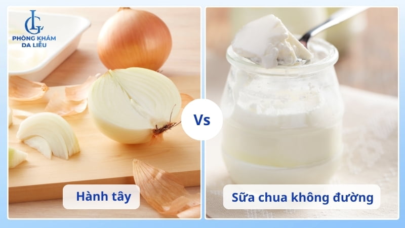 hành tây kết hợp sữa chua trị sẹo lõm hiệu quả