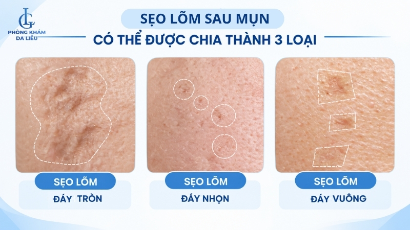 các loại sẹo lõm sau mụn