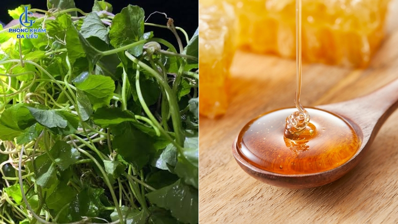 cách trị sẹo rỗ với rau má và mật ong