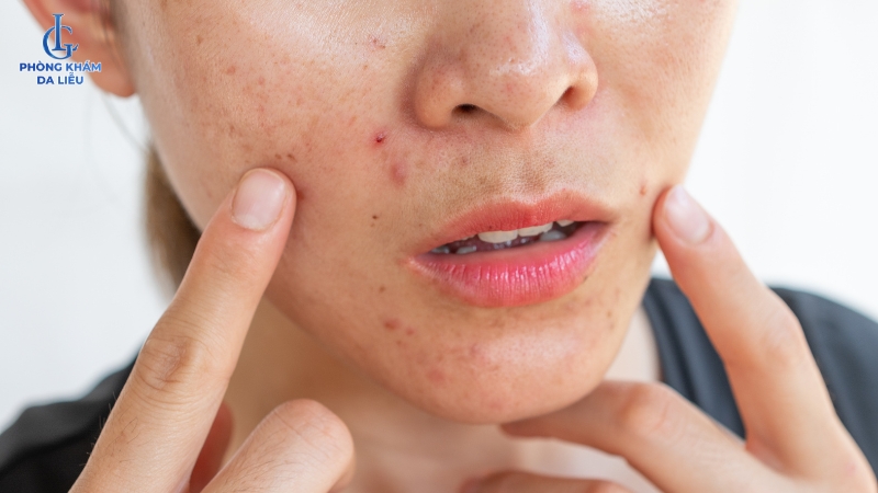 cách trị sẹo rỗ bằng rau má có thể gây kích ứng da