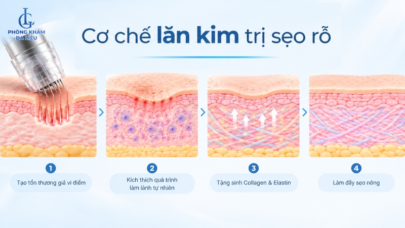 cơ chế lăn kim trị sẹo rỗ