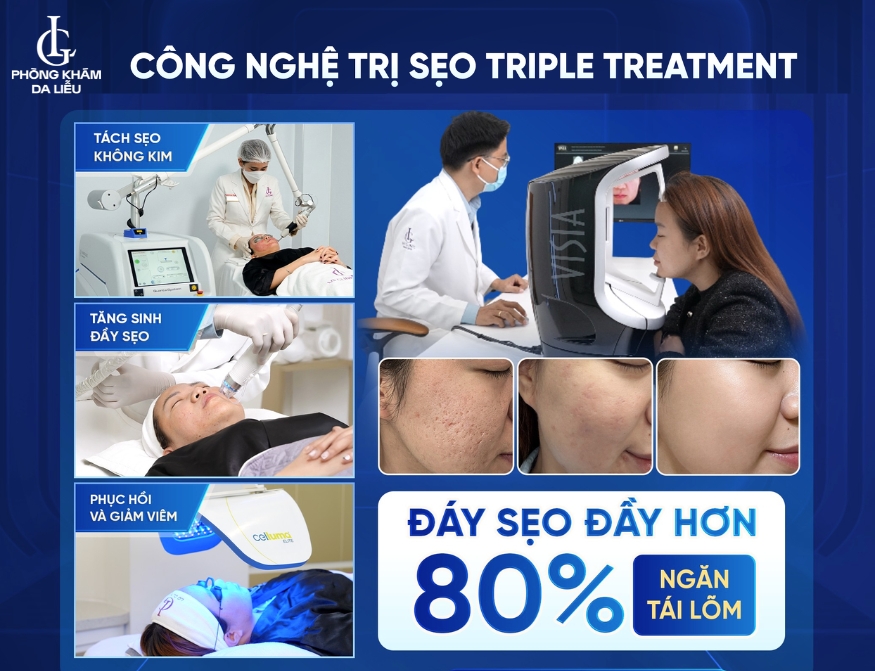 công nghệ điều trị sẹo sau mụn