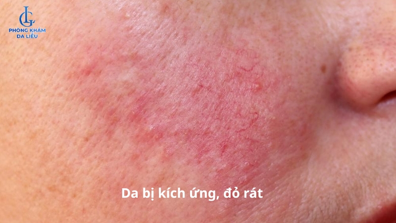 da bị kích ứng khi sử dụng rau má trị sẹo rỗ