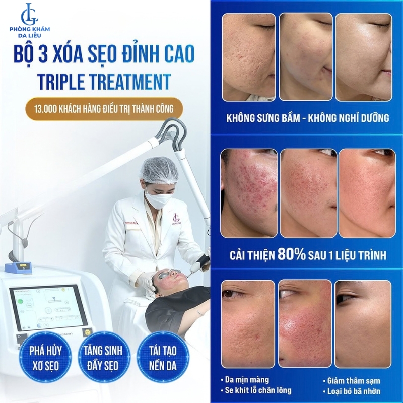 điều trị sẹo rỗ bằng phác đồ triple treatment