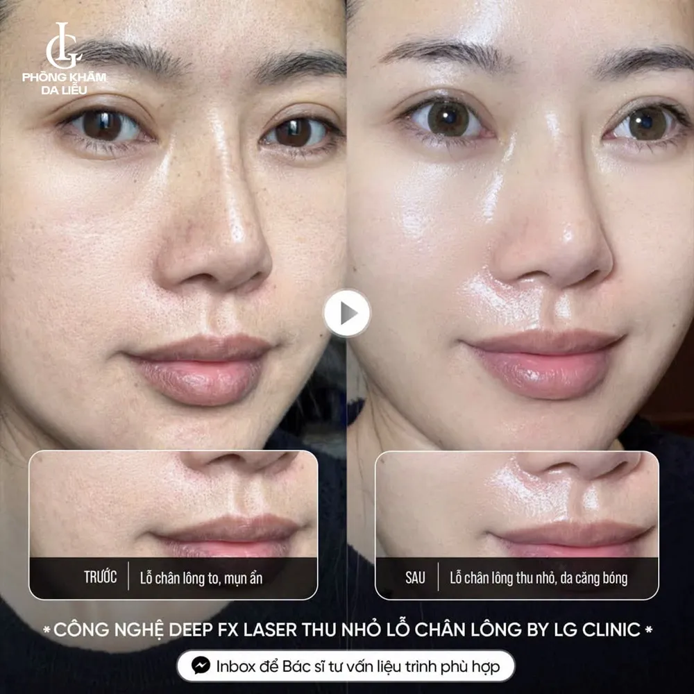 hình ảnh ba thu nhỏ lỗ chân lông