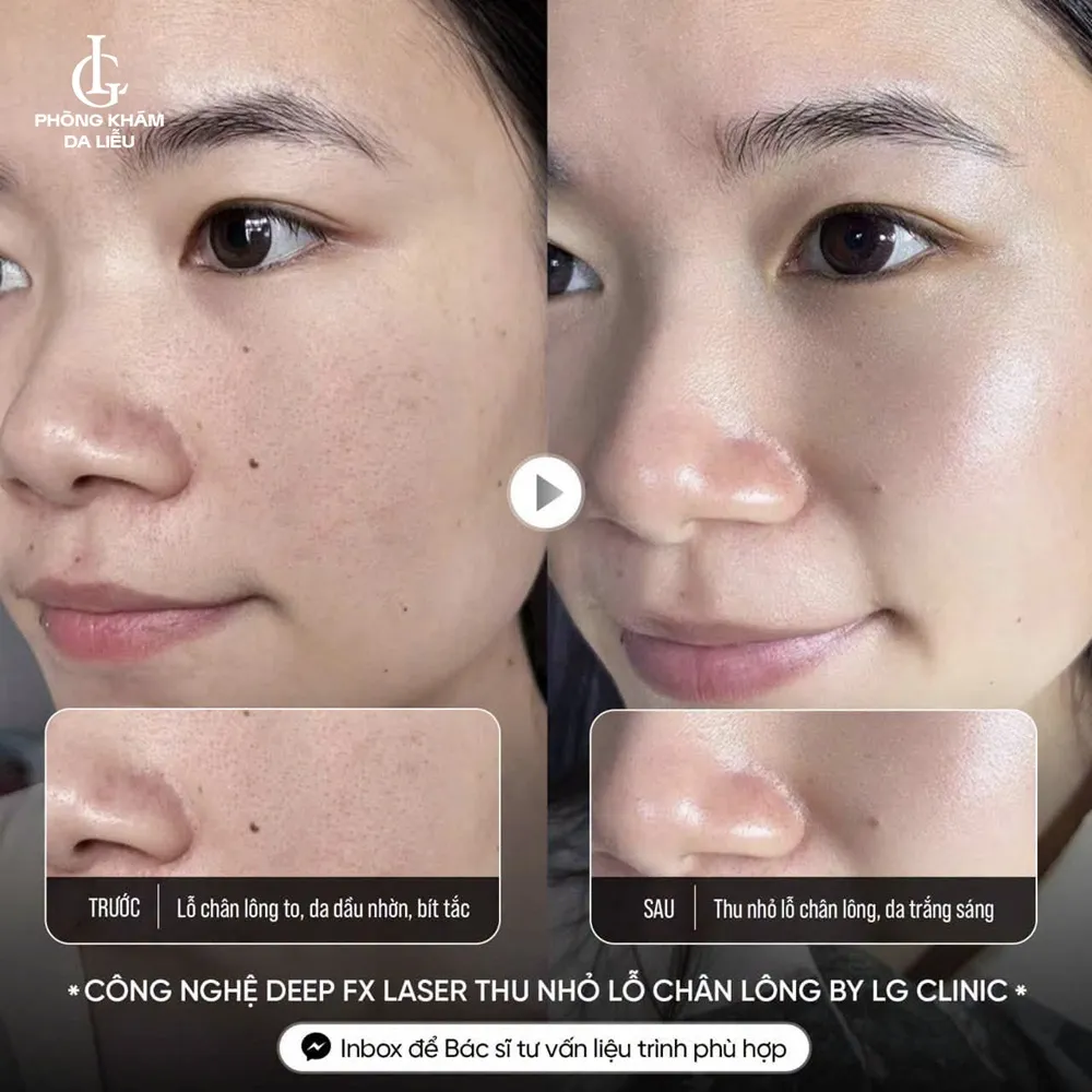 hình ảnh ba thu nhỏ lỗ chân lông