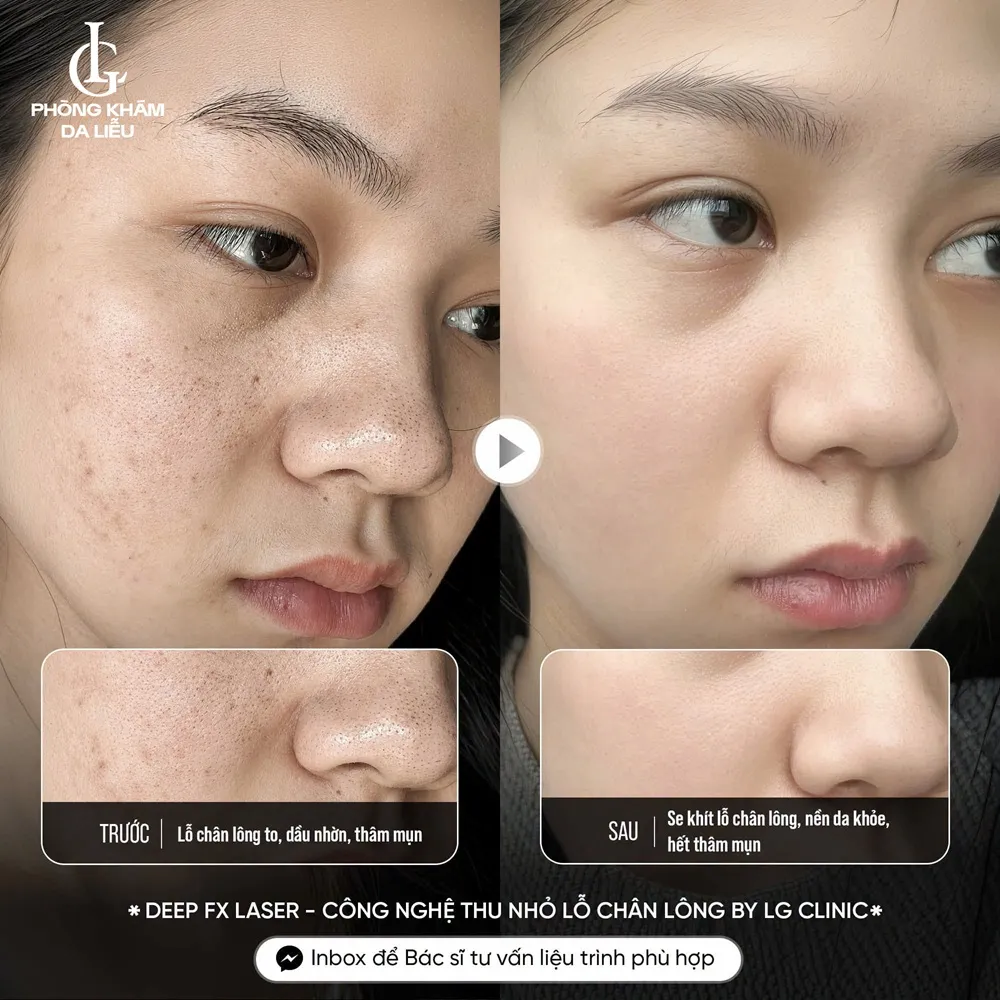 hình ảnh ba thu nhỏ lỗ chân lông