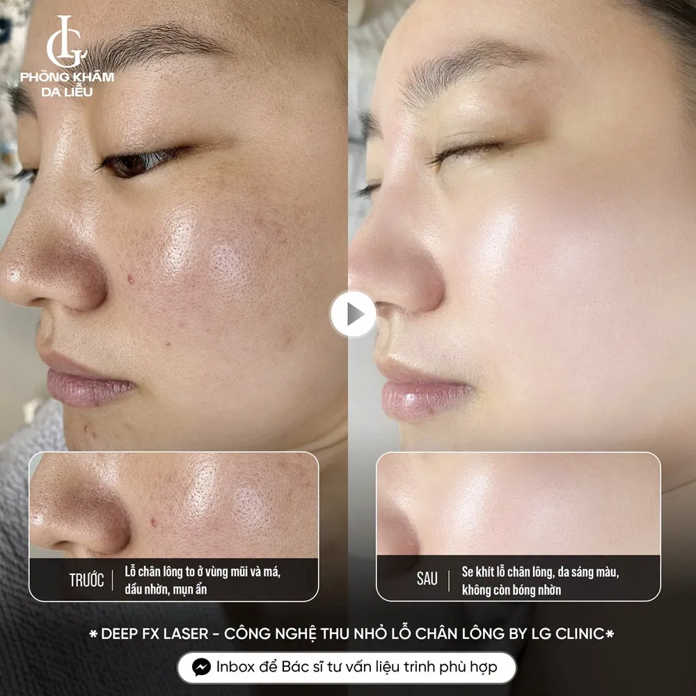 hình ảnh ba thu nhỏ lỗ chân lông