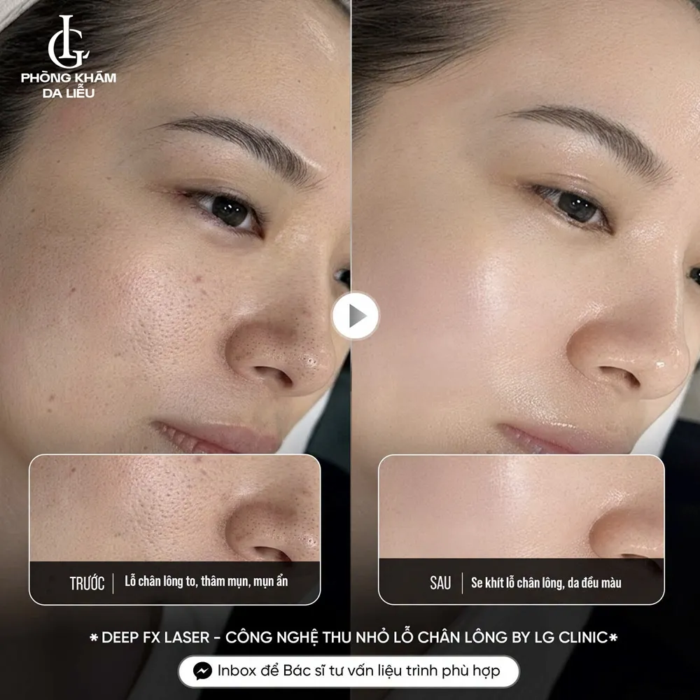 hình ảnh ba thu nhỏ lỗ chân lông