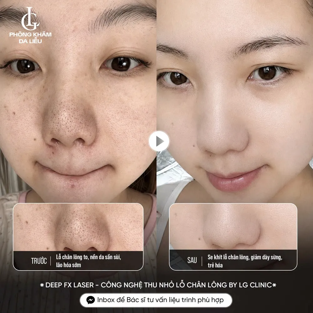 hình ảnh ba thu nhỏ lỗ chân lông