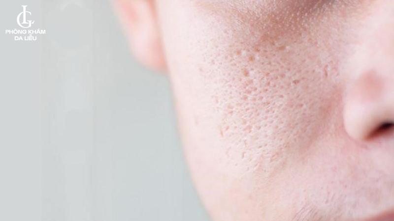 Hình ảnh sẹo rỗ ở gò má
