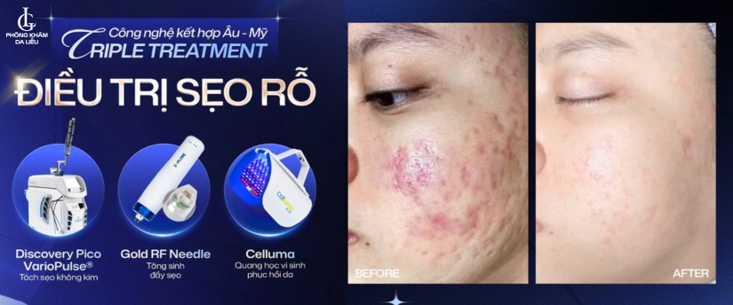 kết quả trị sẹo rỗ bằng triple treatment
