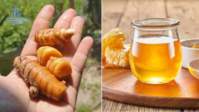 Nghệ tươi giã nát kết hợp mật ong điều trị sẹo rỗ
