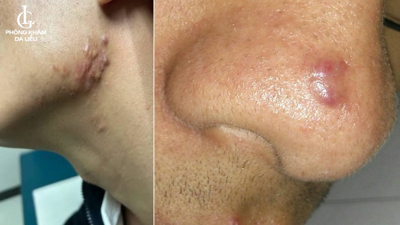 sẹo lồi sau mụn