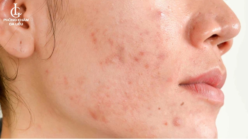 sẹo rỗ do mụn ở má