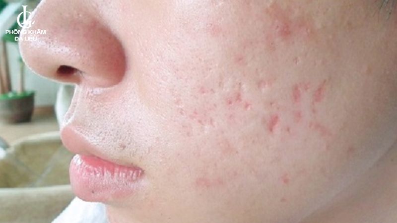 sẹo rỗ do mụn ở mặt