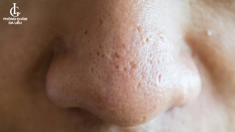 sẹo rỗ do mụn