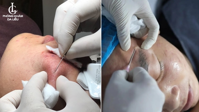 tách đáy sẹo sau mụn