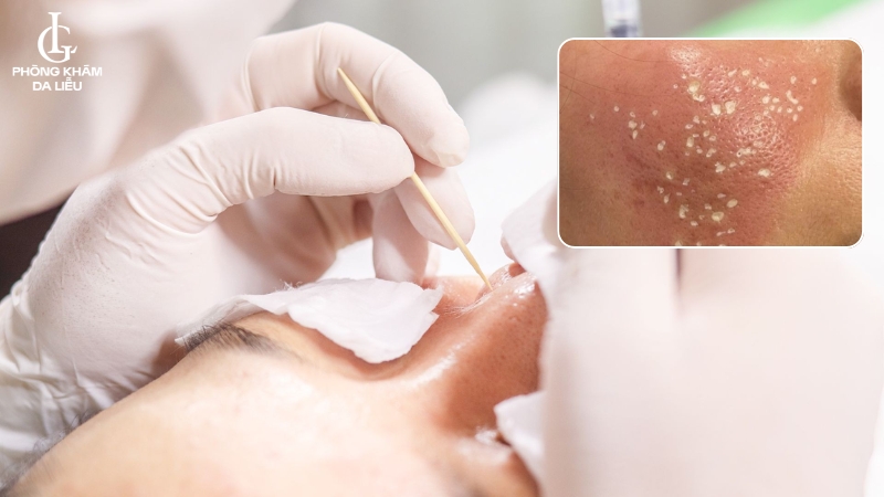 tca cross trị sẹo sau mụn