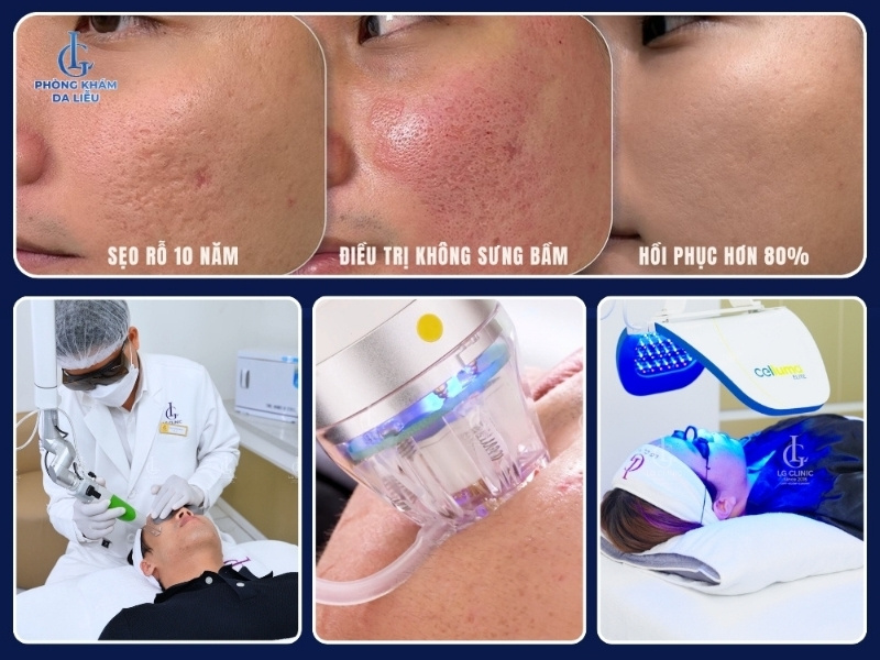 trị sẹo lõm bằng công nghệ cao