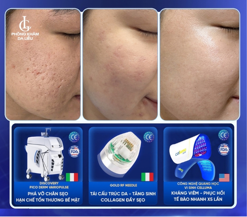 trị sẹo rỗ bằng phác đồ triple treatment