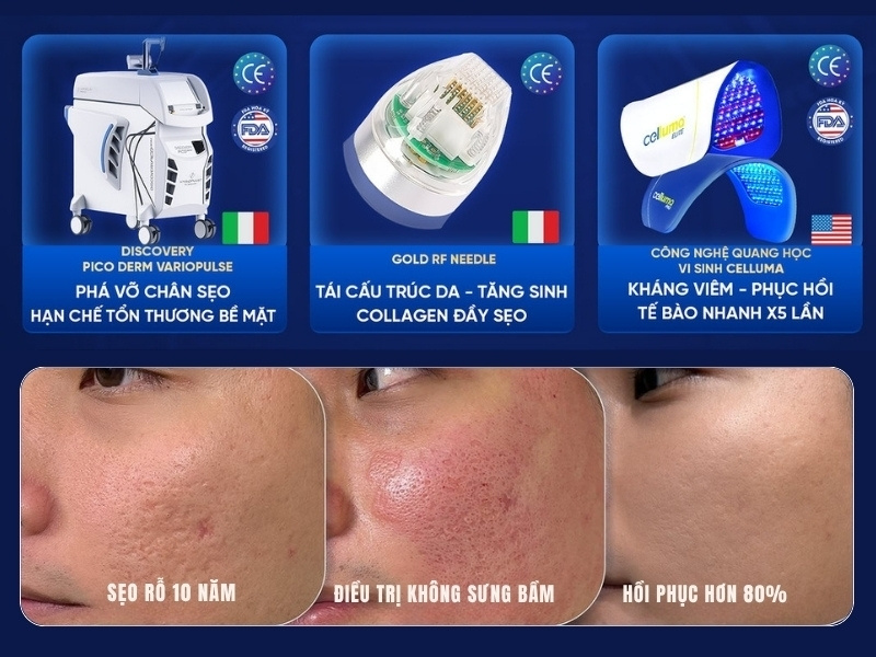 trị sẹo rỗ bằng triple treatment