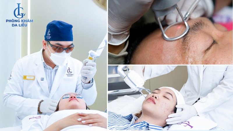 trị sẹo sau mụn tái tạo làn da