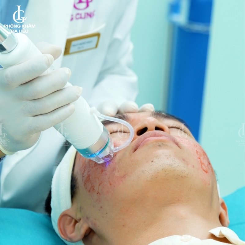 vi kim trị sẹo lõm sau mụn