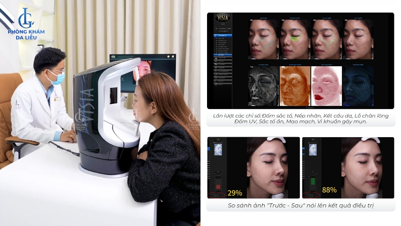 visia soi da điều trị sẹo rỗ